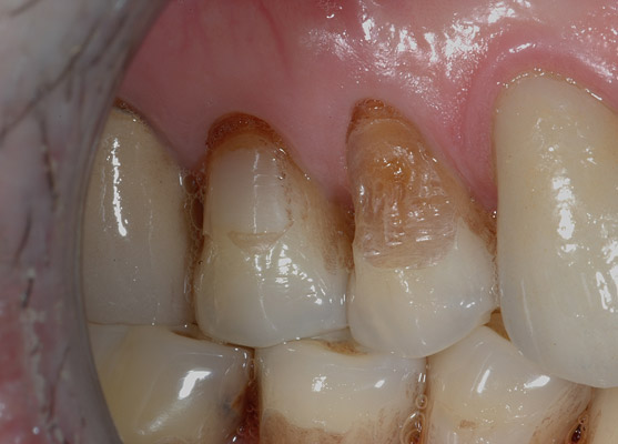 Les facettes dentaires - Dr Sultan